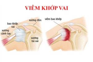 viêm khớp vai
