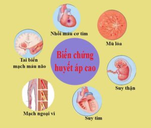 BIEN CHUNG CỦA HUYET AP CAO