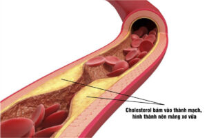 Cholesterol bám vào thành mạch