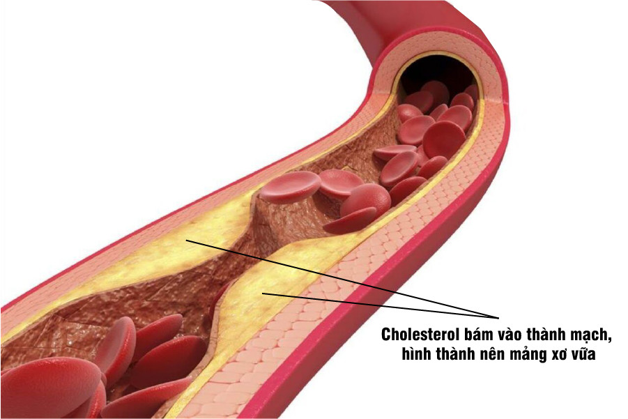 Cholesterol bám vào thành mạch