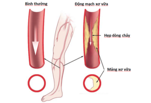 Bệnh động mạch ngoại biên (PAD)