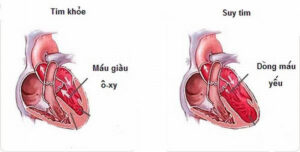 Bệnh suy tim