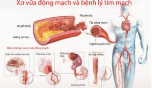 tác hại của mỡ máu cao