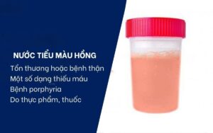 nước tiểu màu hồng