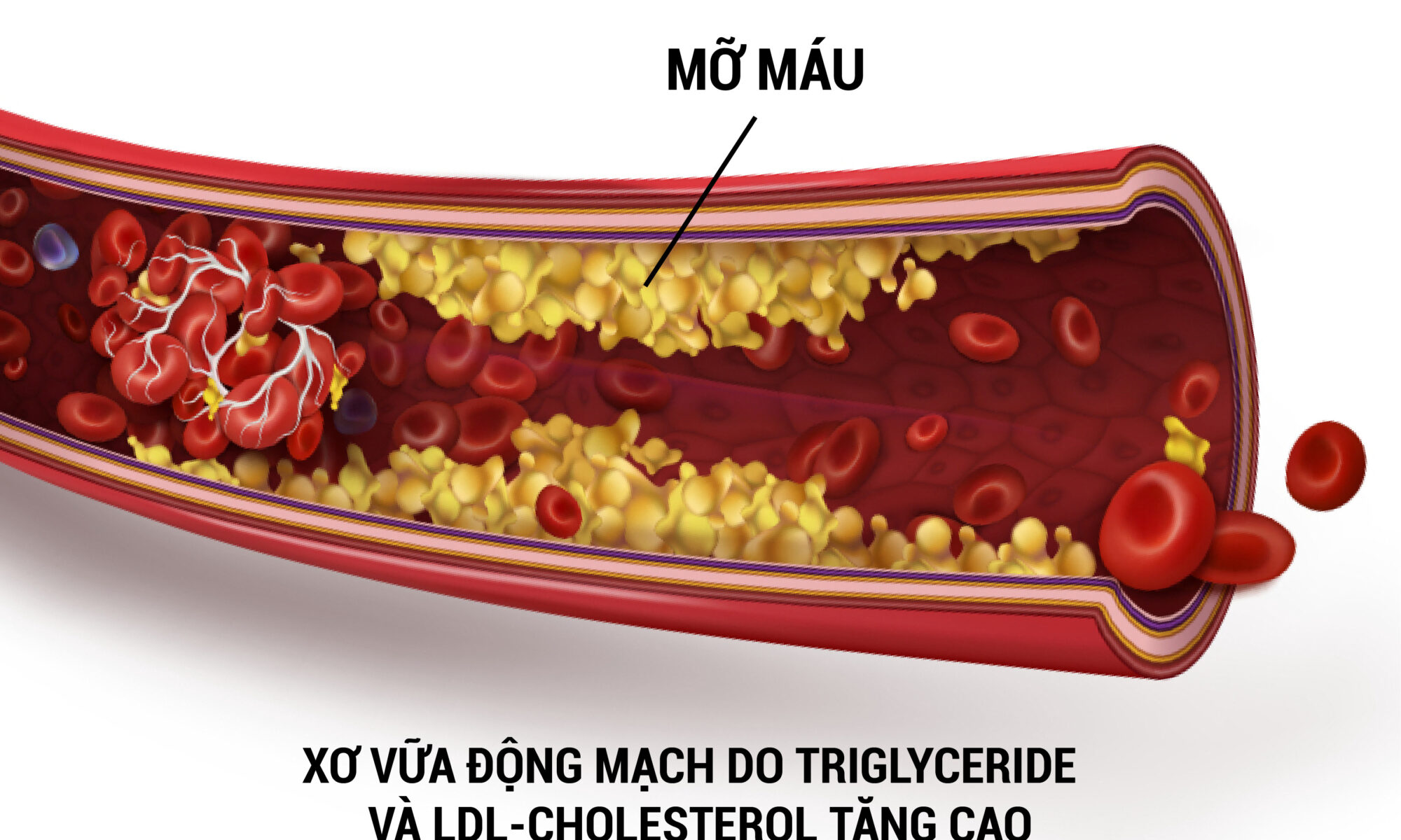 tác hại của triglyceride cao