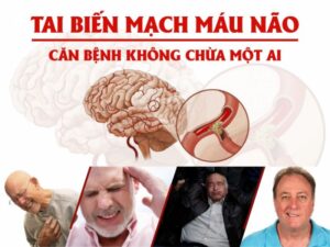 tai biến