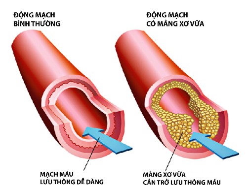 xơ vữa động mạch