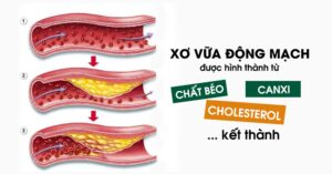 triệu chứng mỡ máu