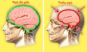 hau-qua-cua-thieu-ngu