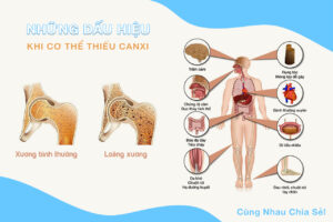 Những dấu hiệu khi cơ thể bạn thiếu canxi