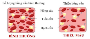 thiếu máu có gây buồn ngủ không?